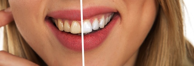 Gelbe Zähne - Ursachen und Gegenmaßnahmen