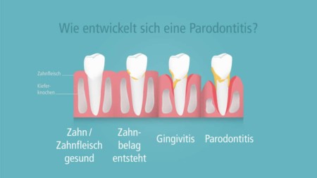 Wie entsteht eine Parodontitis?